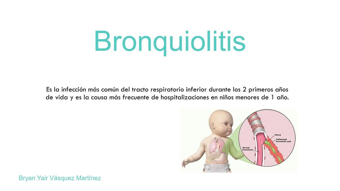 Bronquiolitis