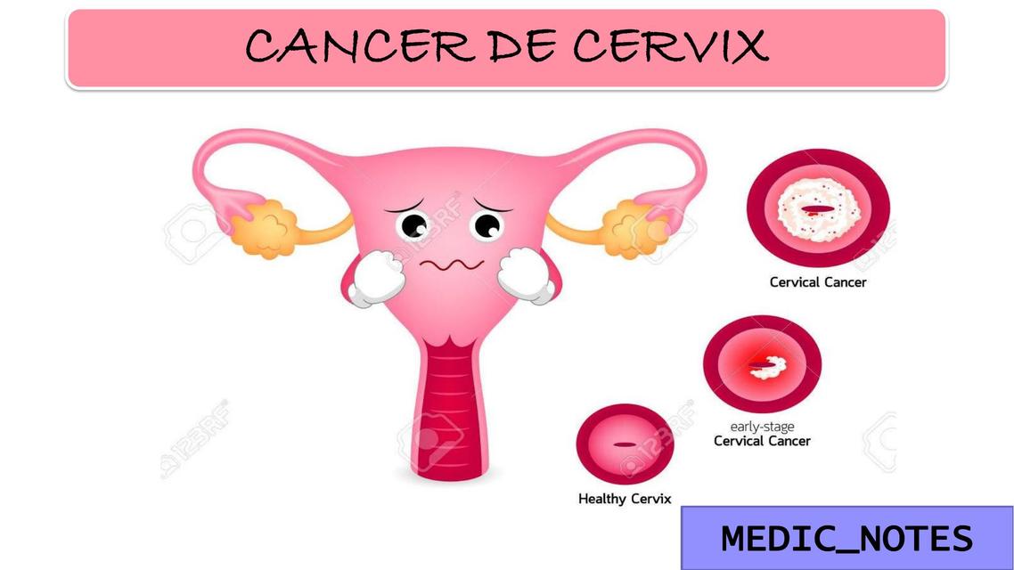 CANCER DE CERVIX