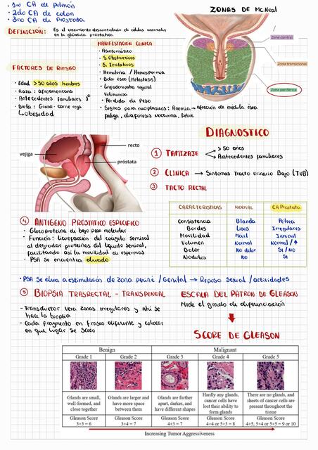 CANCER DE PROSTATA