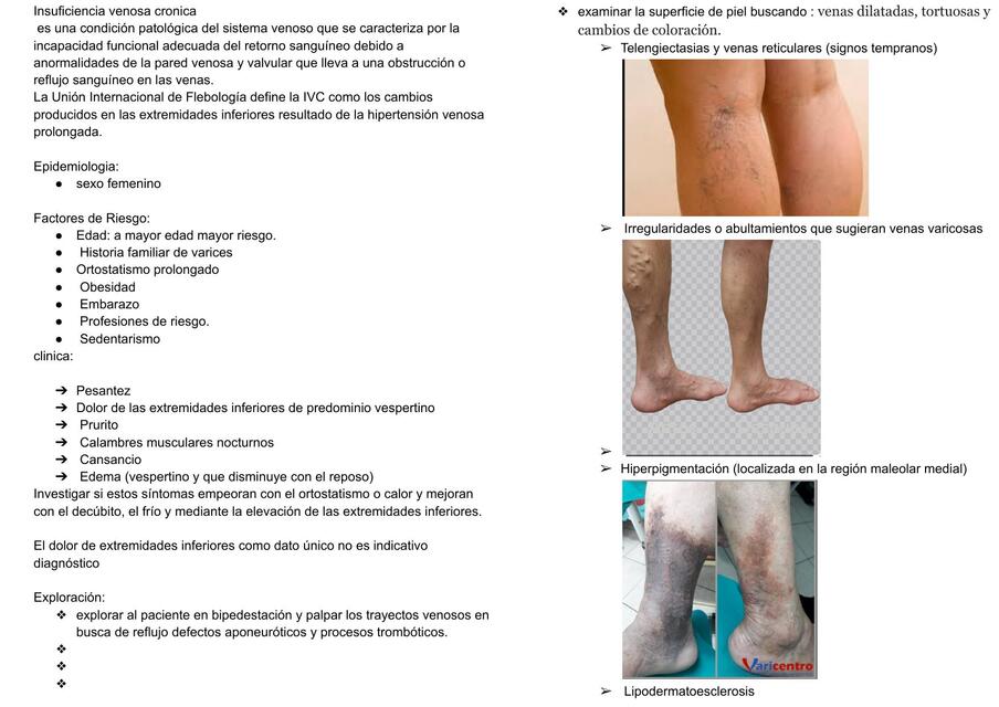 Insuficiencia venosa cronica