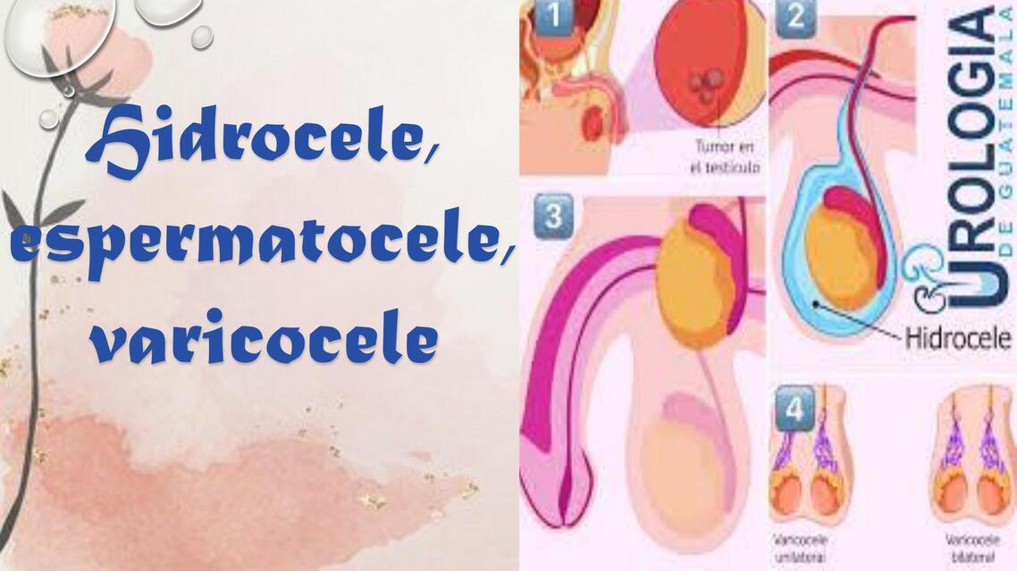 HIDROCELE ESPERMATOCELE