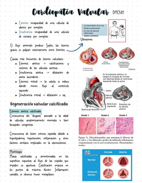 Cardiopatía Valvular