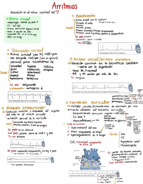 Arritmias