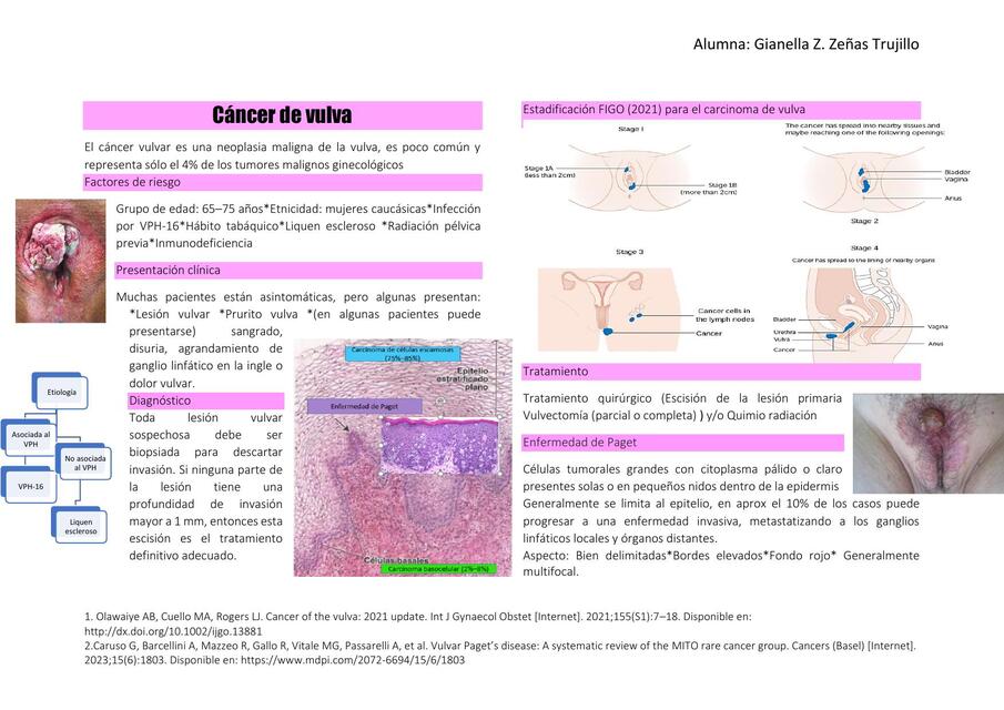 C ncer De Vulva Zulema UDocz c-ncer-de-vulva-zulema-udocz