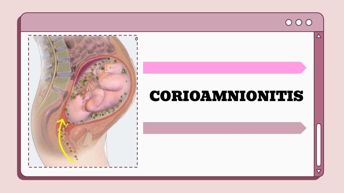 CORIOAMNIONITIS (Triple I)