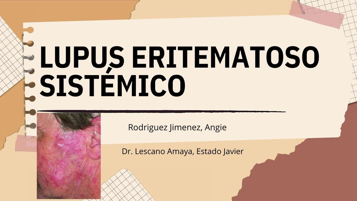 Lupus eritematoso