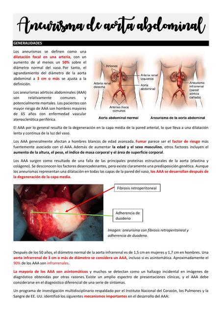 Aneurisma de aorta abdominal