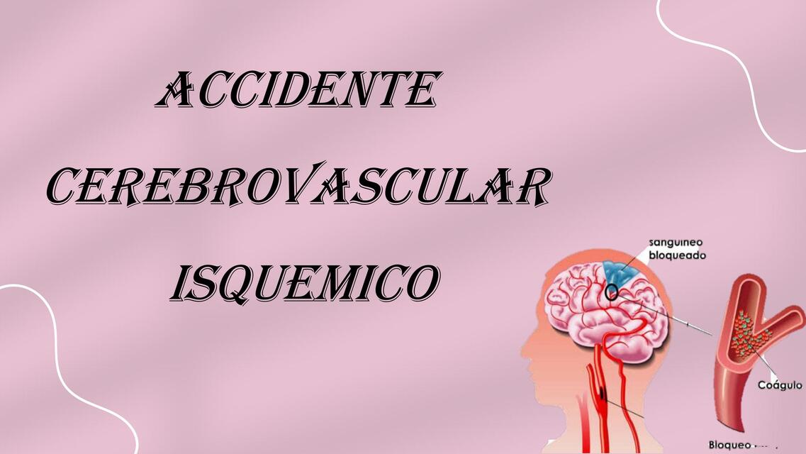 ACV ISQUÉMICO