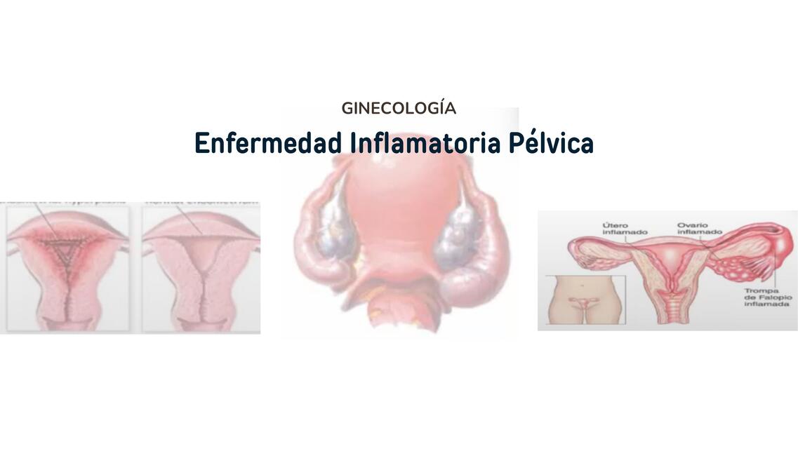 Enfermedad Pelvica Inflamatoria