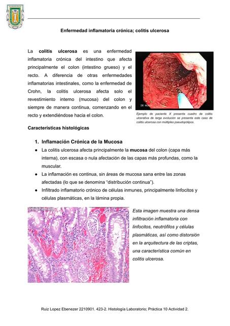 INVESTIGACIÓN: Enfermedad inflamatoria crónica colitis ulcerosa