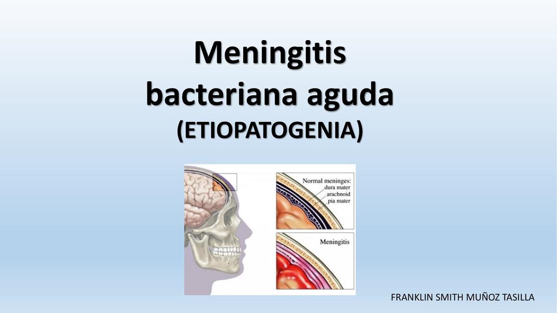 Meningitis bacteriana