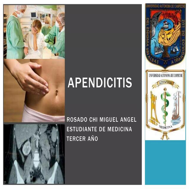 Apendicitis