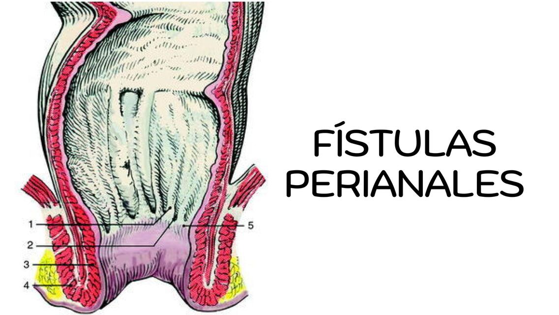 FISTULAS ANORRECTALES