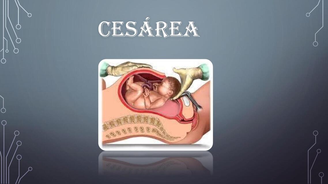 cesarea