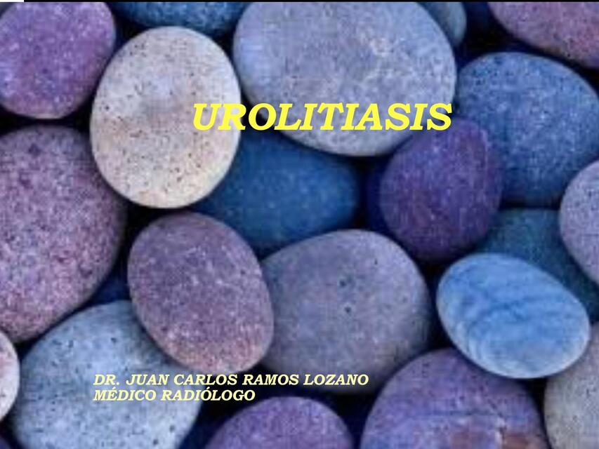 UROLITIASIS Y EMBARAZO