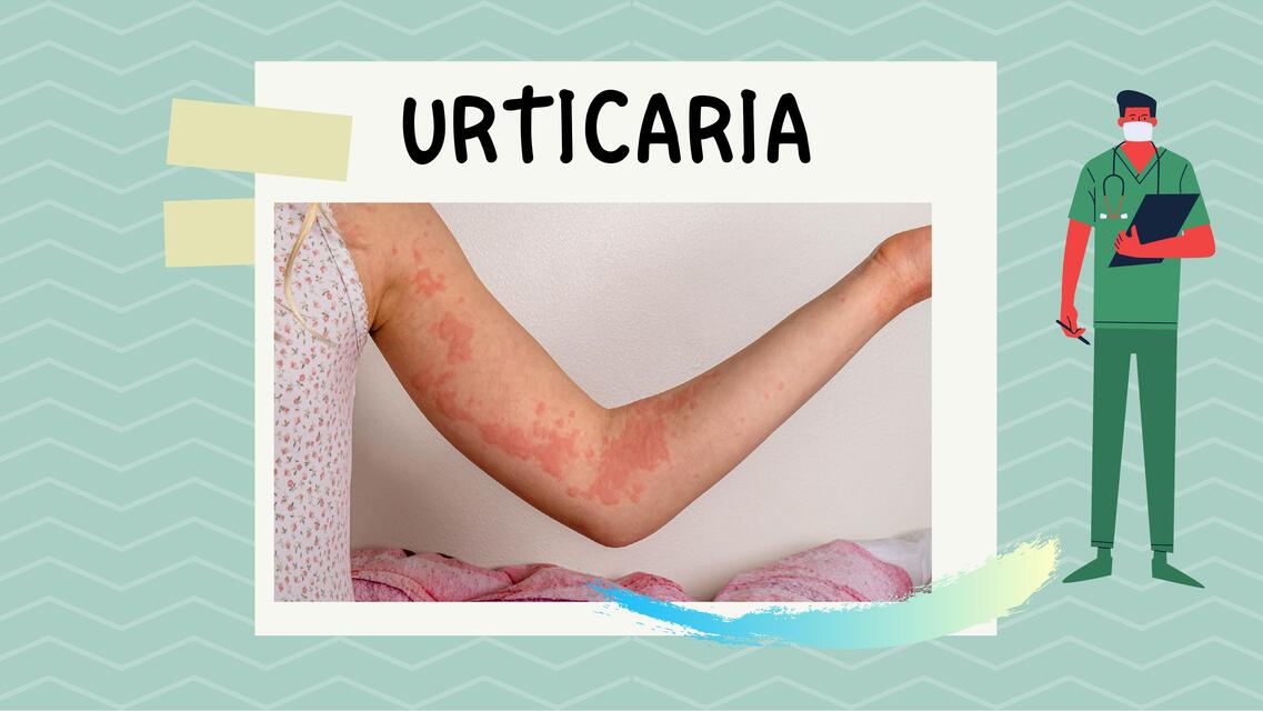 URTICARIA