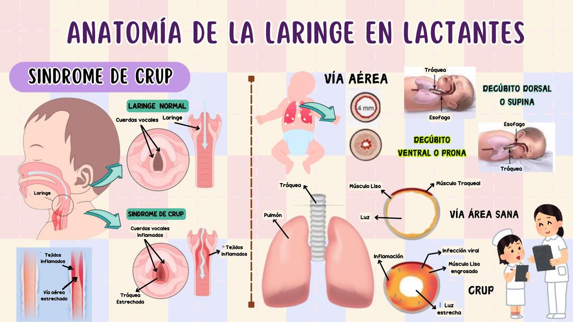 Sindrome de crup