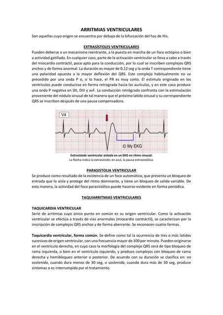 Arritmias ventricular