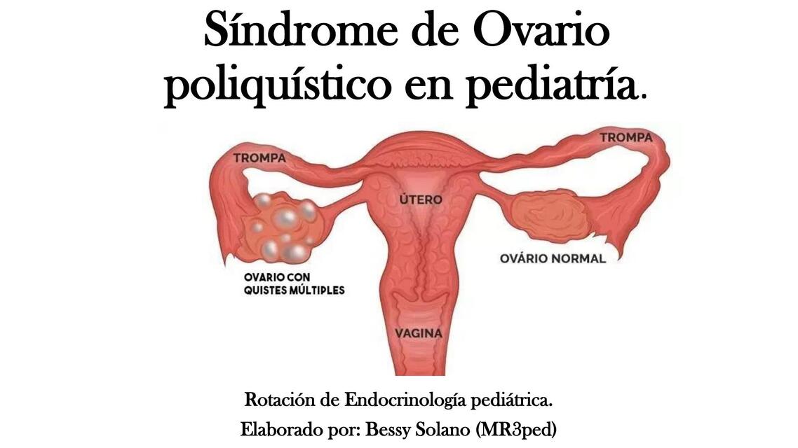 Síndrome de Ovario poliquístico en pediatría