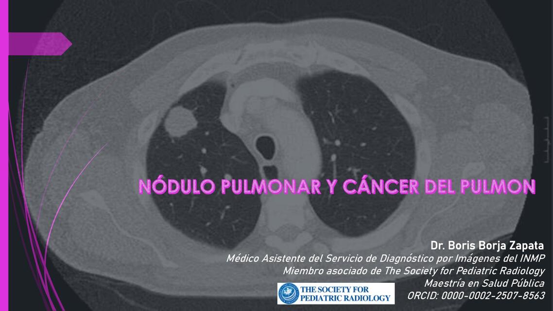 II 5 NÓDULO PULMONAR Y CÁNCER DE PULMÓN DR BORIS B