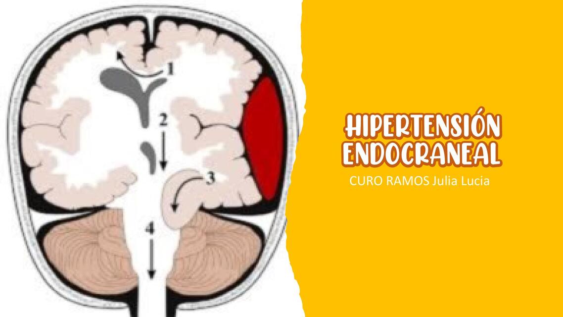 HIPERTENSIÓN ENDOCRANEAL