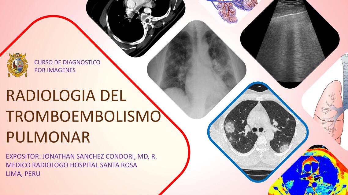 III 2 TROMBOEMBOLISMO PULMONAR DR JONATHAN SANCHEZ