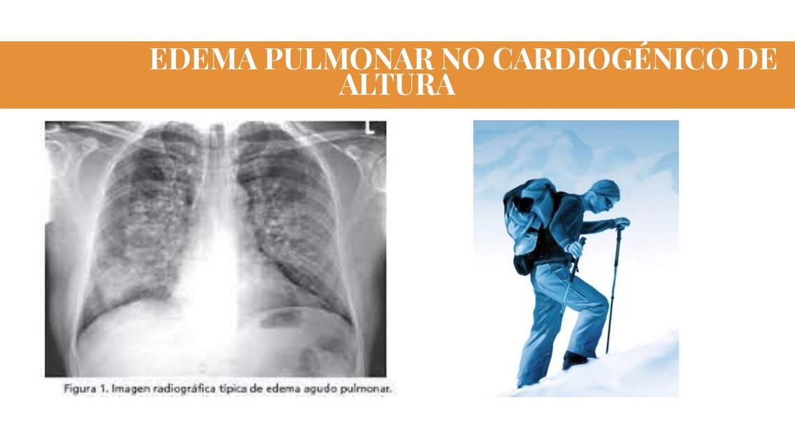 EDEMA PULMONAR NO CARDIOGÉNICO DE ALTURA