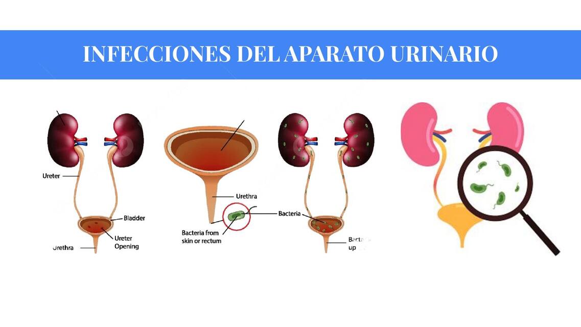 INFECCIONES DEL APARATO URINARIO