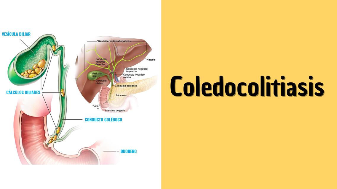 COLEDOCOLITIASIS Y COLANGITIS