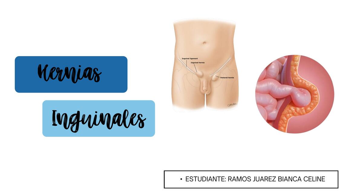 HERNIAS INGUINOCRURALES