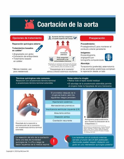 Coartación de la aorta