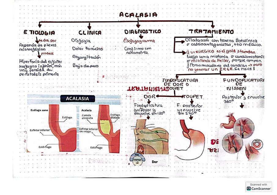 ACALASIA