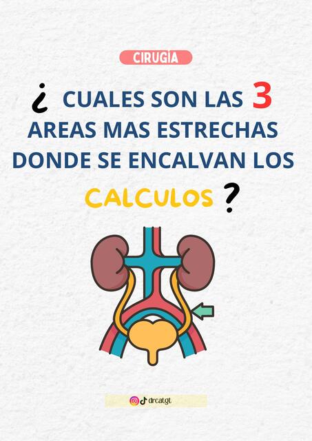 Calculos ureterales