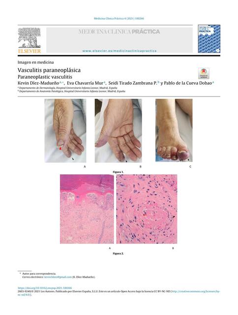 Vasculitis paraneoplasica1