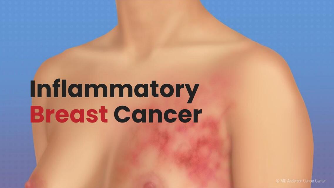 nflammatory Breast Cancer