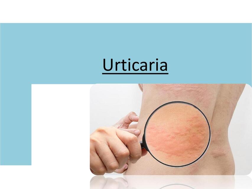 URTICARIA