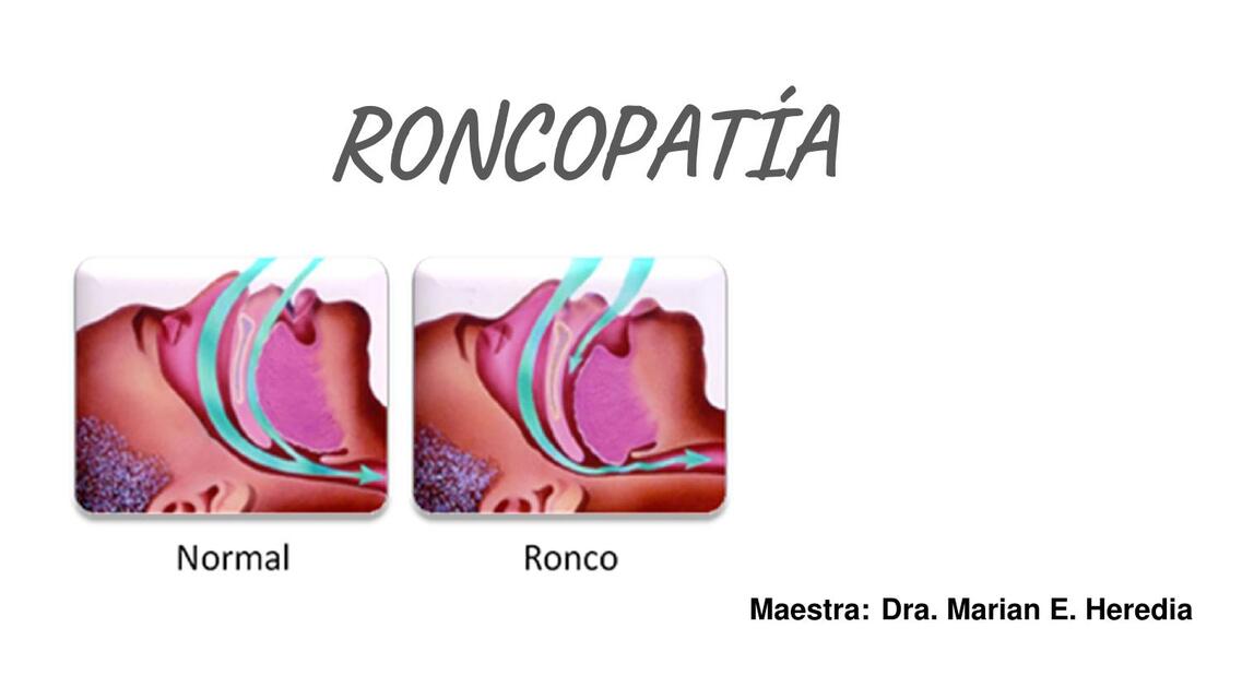 Roncopatia