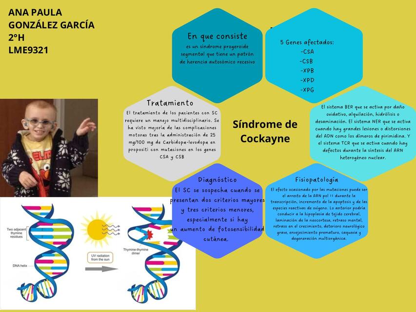 Síndrome de Cockayne anapaulagonzalezgarcia