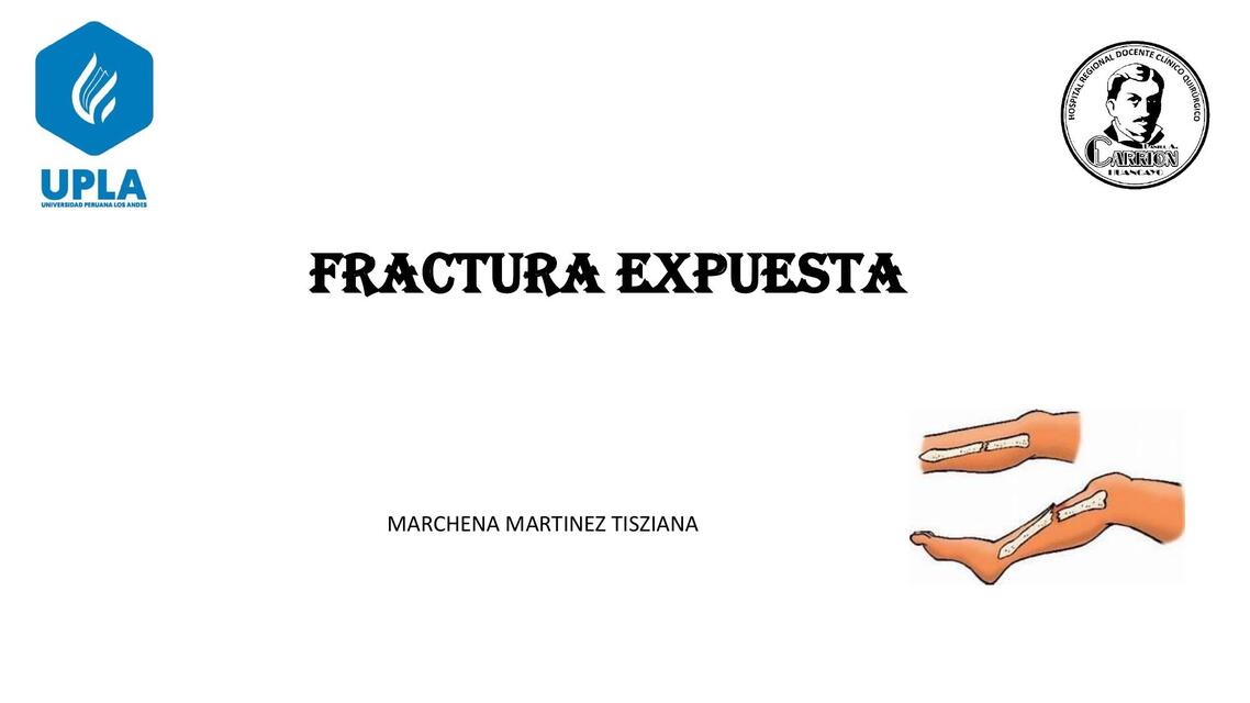 FRACTURA EXPUESTA