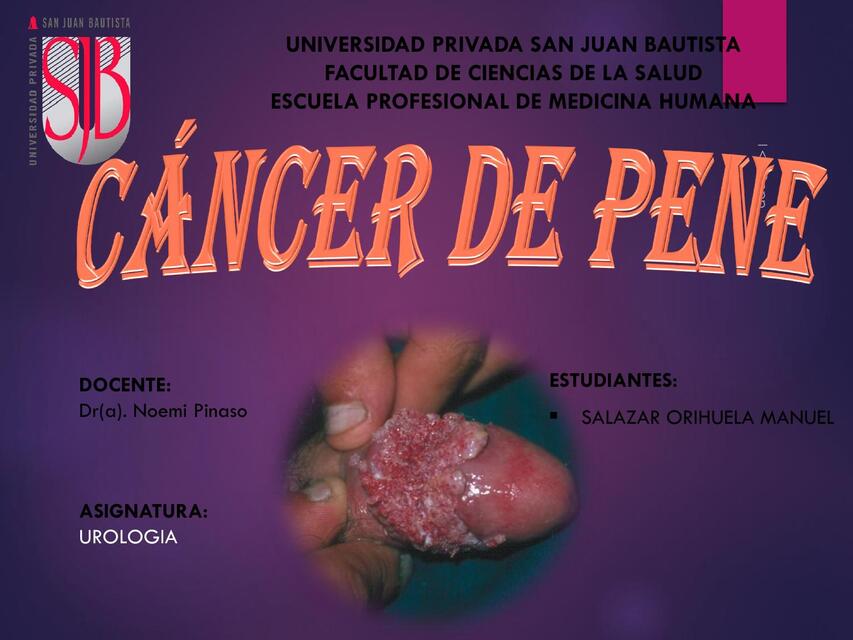 Cancer de Pene