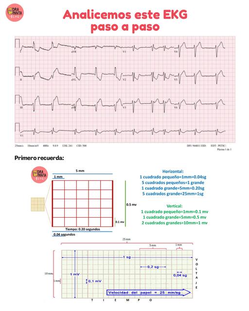 Análisis de EKG