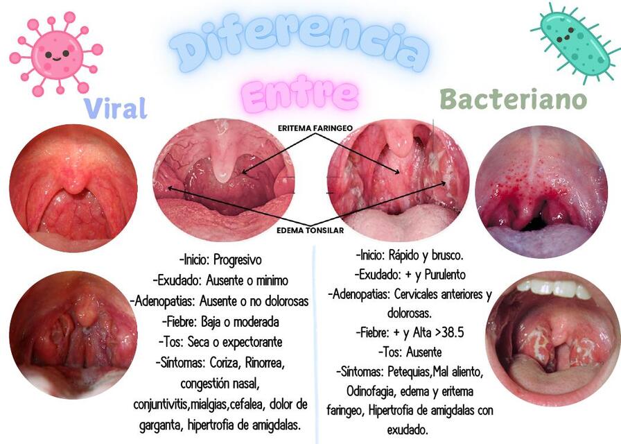 Diferencia entre faringitis Viral y Bacteriana