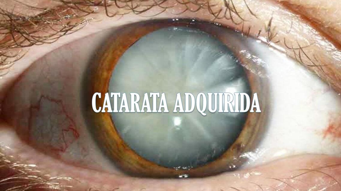 CATARATA ADQUIRIDA