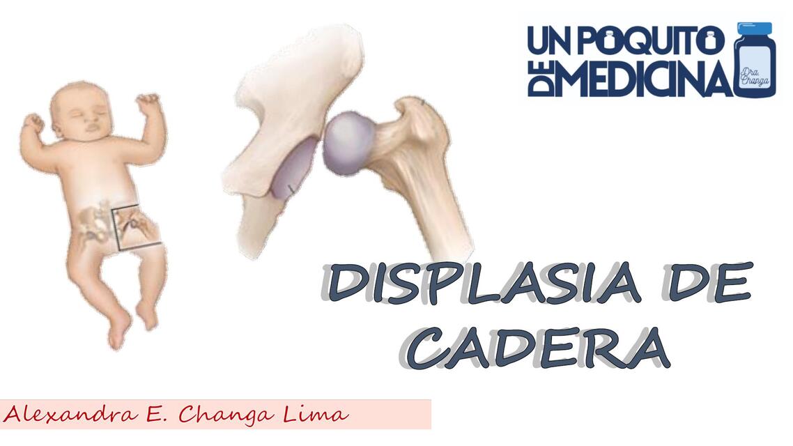 DISPLASIA DE CADERA