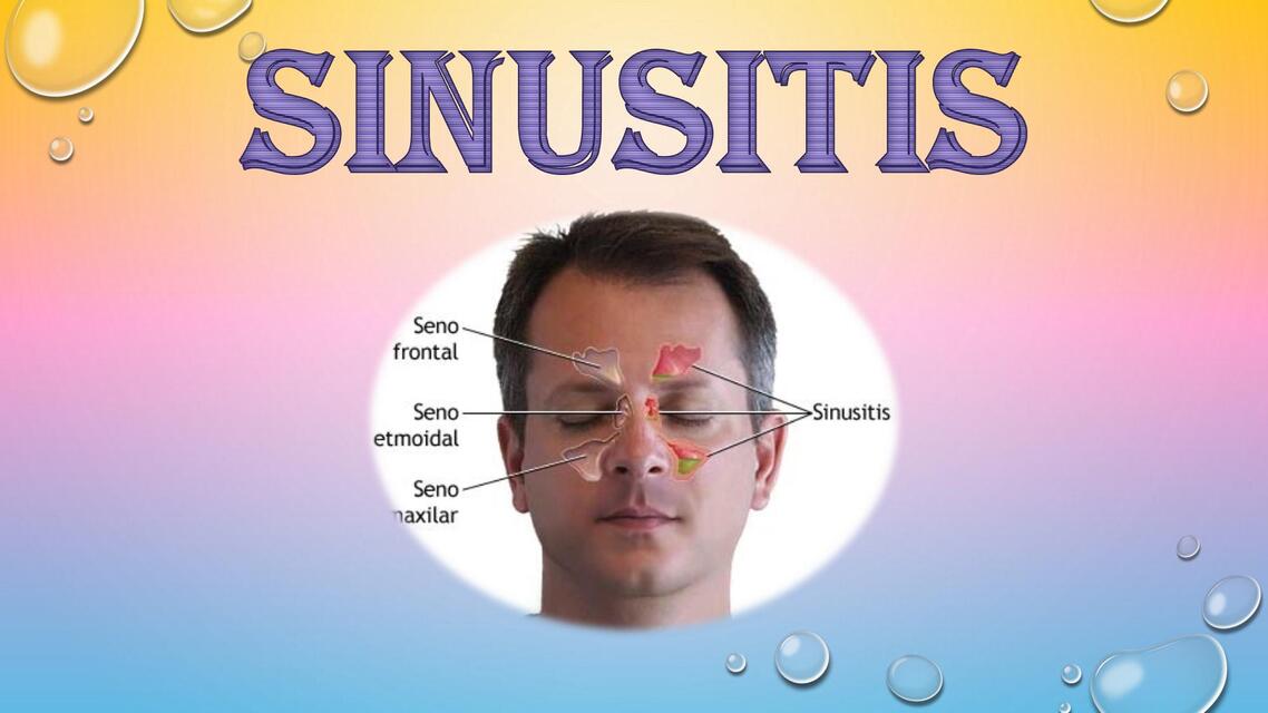 SINUSITIS