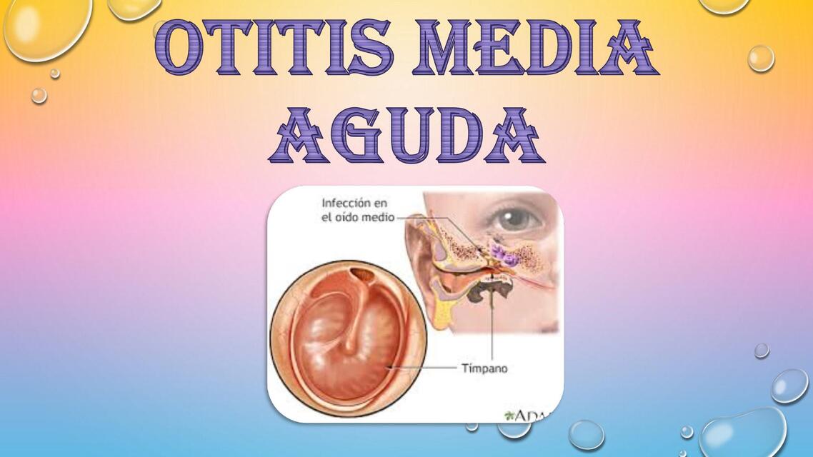 OTITIS MEDIA AGUDA