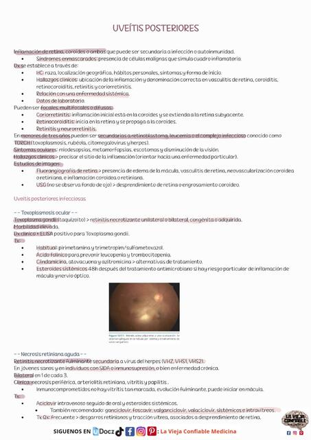 UVEITIS POSTERIORES