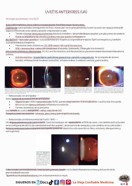 UVEITIS ANTERIORES