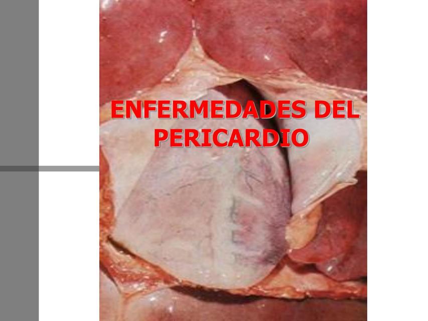 Enfermedades del Pericardio