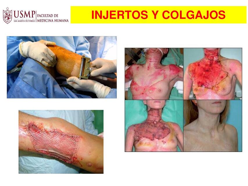 Injertos y colgajos